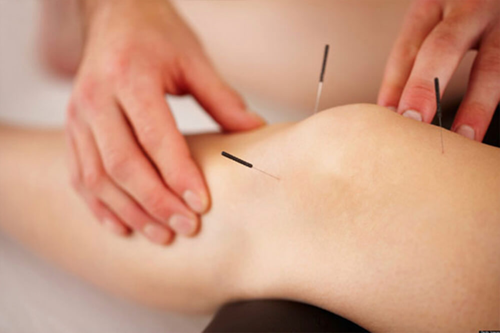 Puncion seca para contracturas musculares